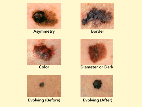Moderna, melanoma,